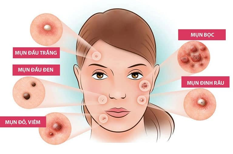 Hỗ trợ trị mụn chuẩn Y khoa